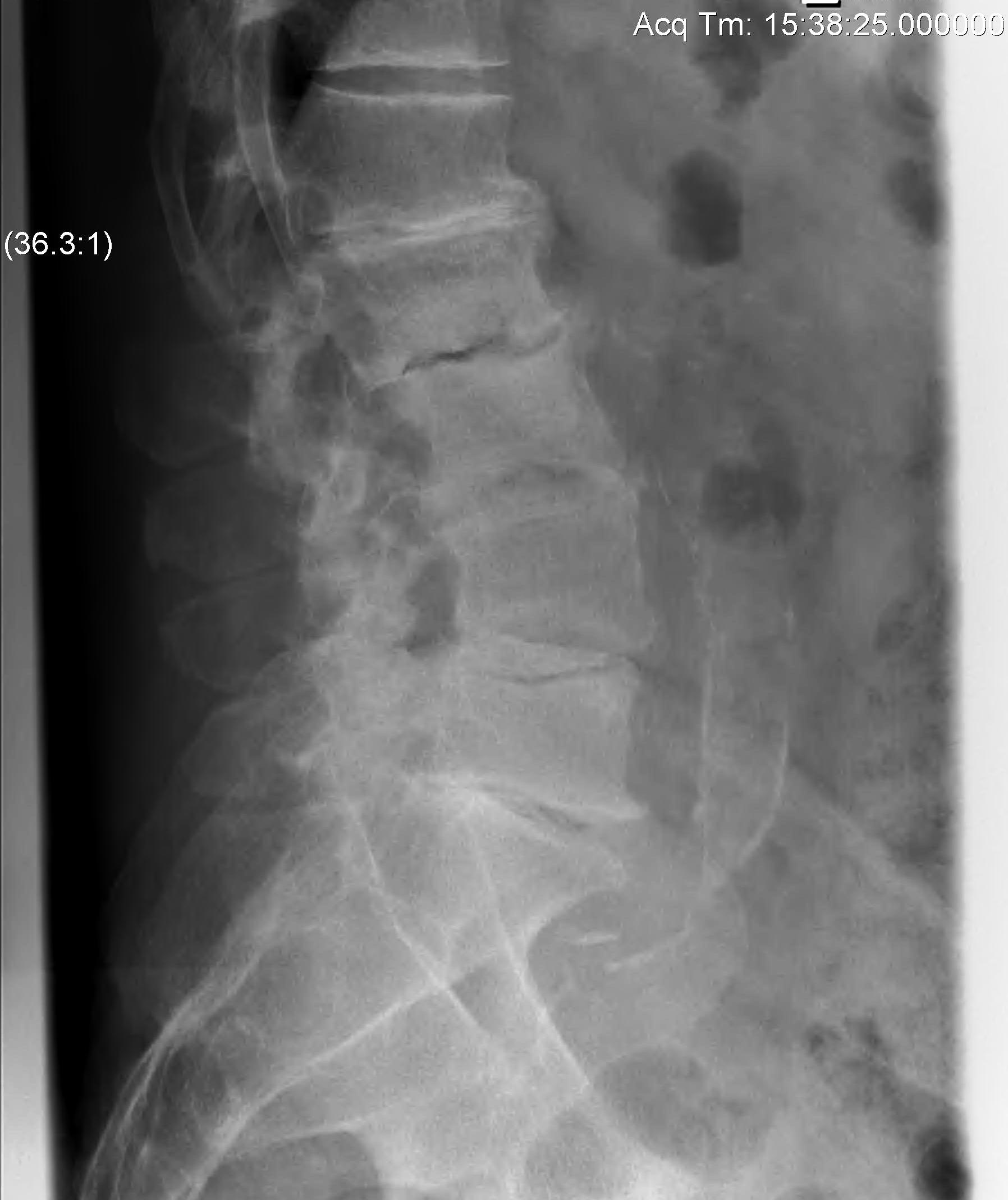 Degenerative Scoliosis Lateral